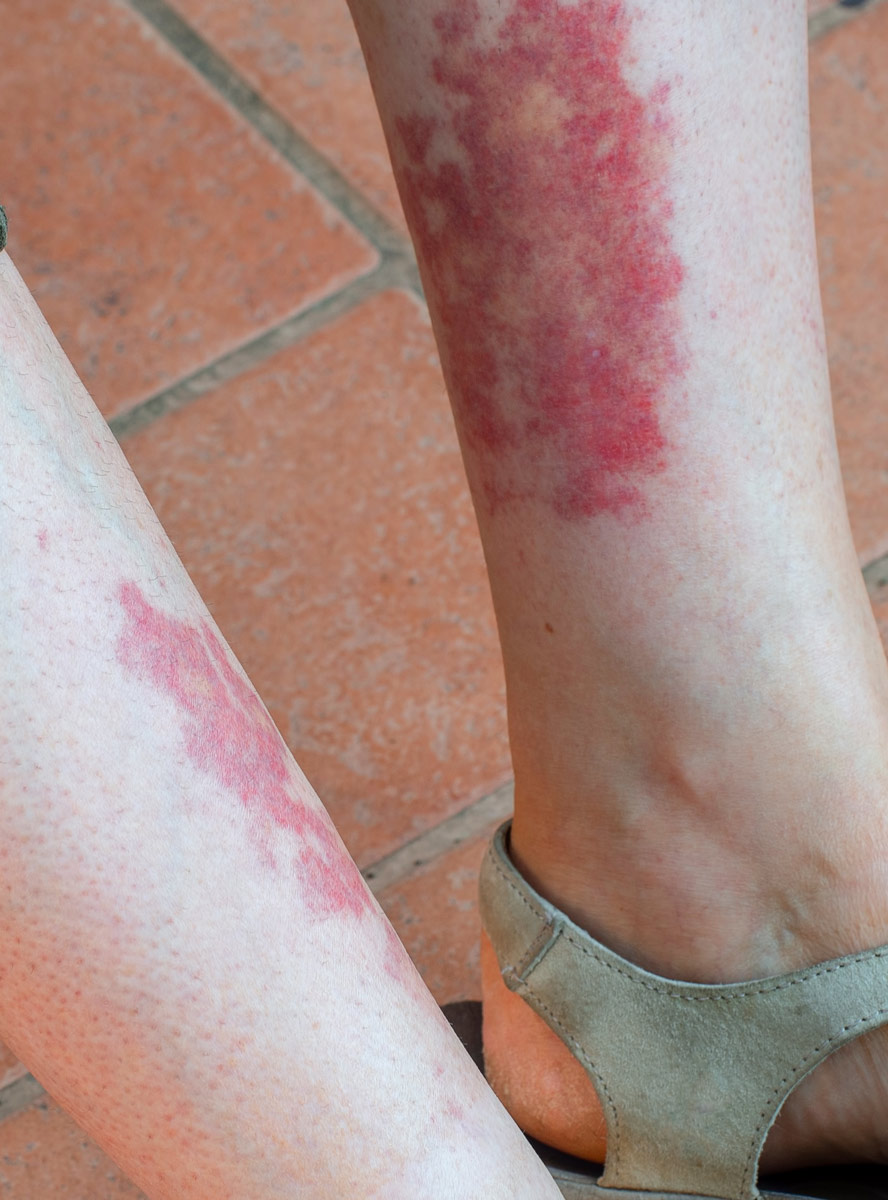 enfermedades-hematologicas-mas-frecuentes