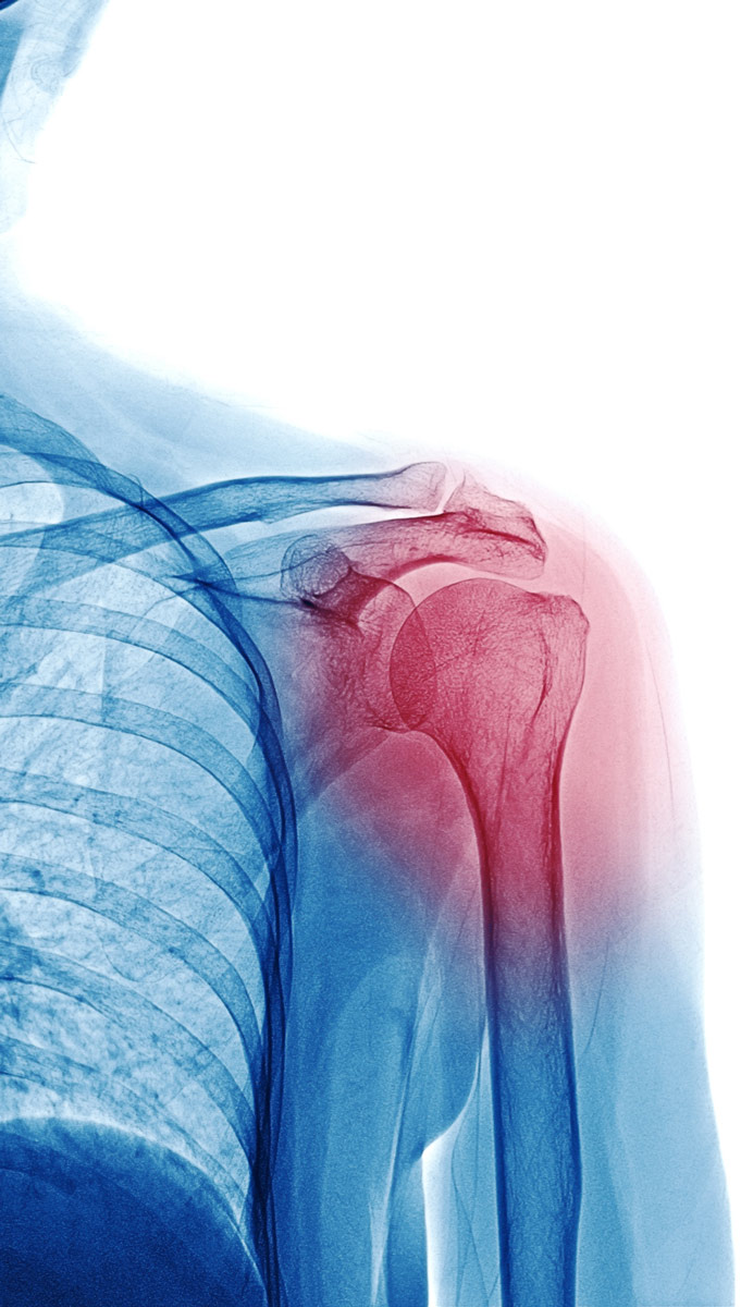 enfermedades-oseas-frecuentes