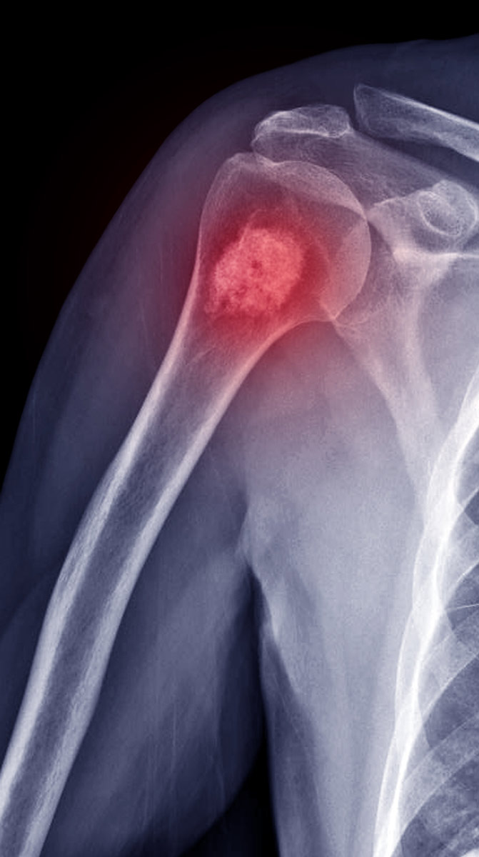 enfermedades-tumorales-frecuentes