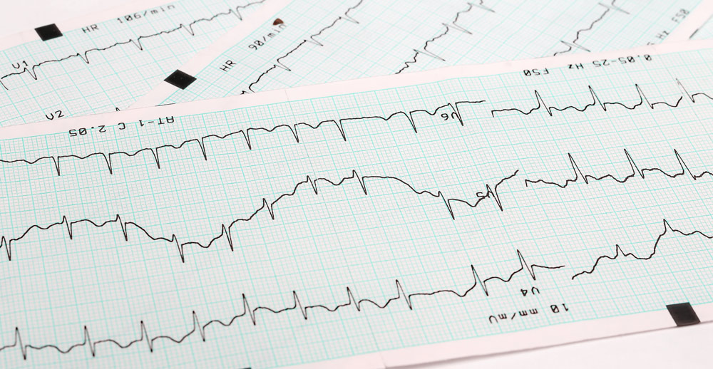 que-son-enfermedades-cardiovasculares