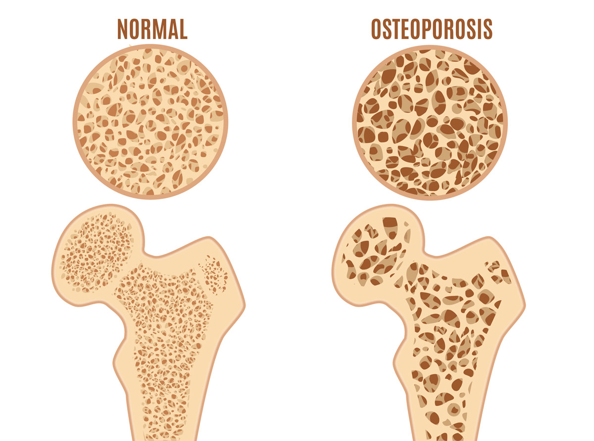 que-son-las-enfermedades-oseas