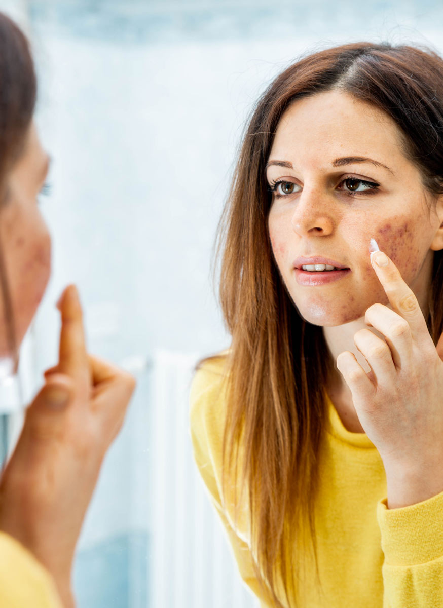 acne tratamiento facial